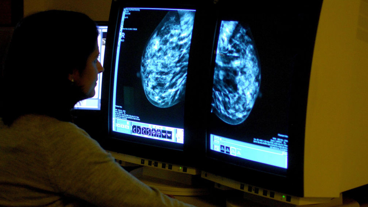 Targeted drug shrinks tumors in 3 out of 4 patients with advanced breast cancer — Safety Harbor Schools news